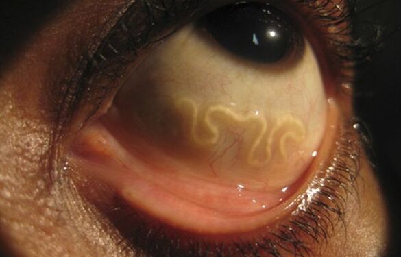 หนอน Loa Loa อาศัยอยู่ในดวงตาของมนุษย์และทำให้ตาบอด
